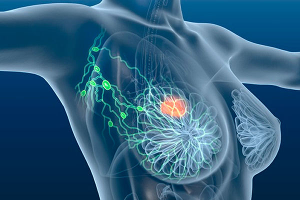 Progetto di screening dei tumori della mammella